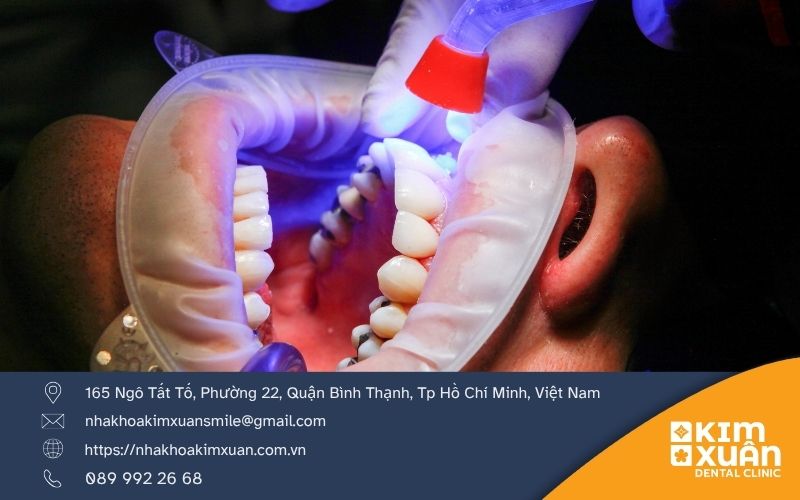 Trám Răng Lấy Tủy Giá Bao Nhiêu