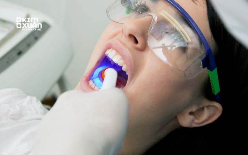 Trám Răng Nha Khoa Kim Xuân