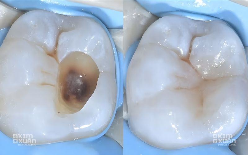 Trám Răng Sâu Lỗ To Ảnh Trước Và Sau Tại Nha Khoa Kim Xuân