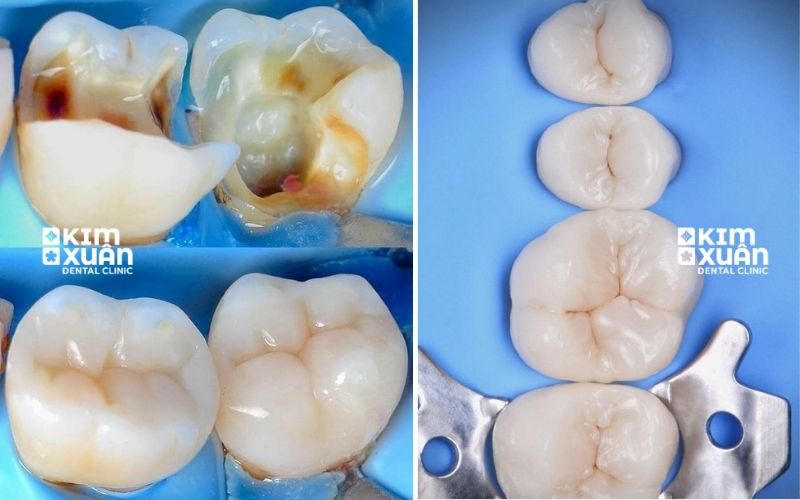 Hình ảnh trám răng composite răng hàm trước và sau
