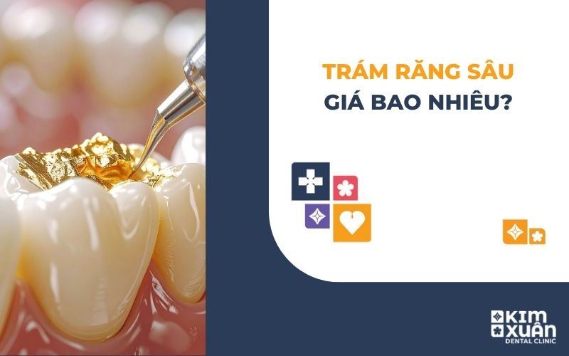 Trám Răng Sâu Giá Bao Nhiêu Tại TP. HCM