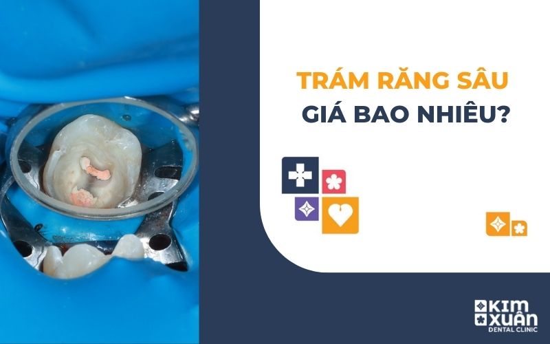 Trám Răng Sâu Giá Bao Nhiêu