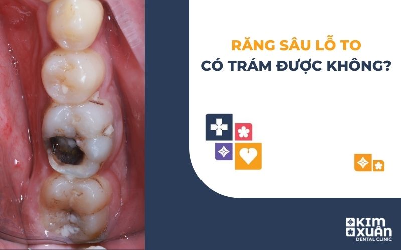 Răng Sâu Lỗ To Có Trám Được Không