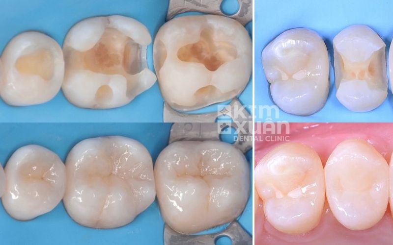 Trám Răng Sâu Ở Đâu Tốt Tại TP HCM và Bình Thạnh