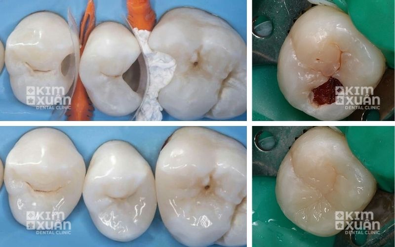 Hình ảnh điều trị răng sâu răng hàm