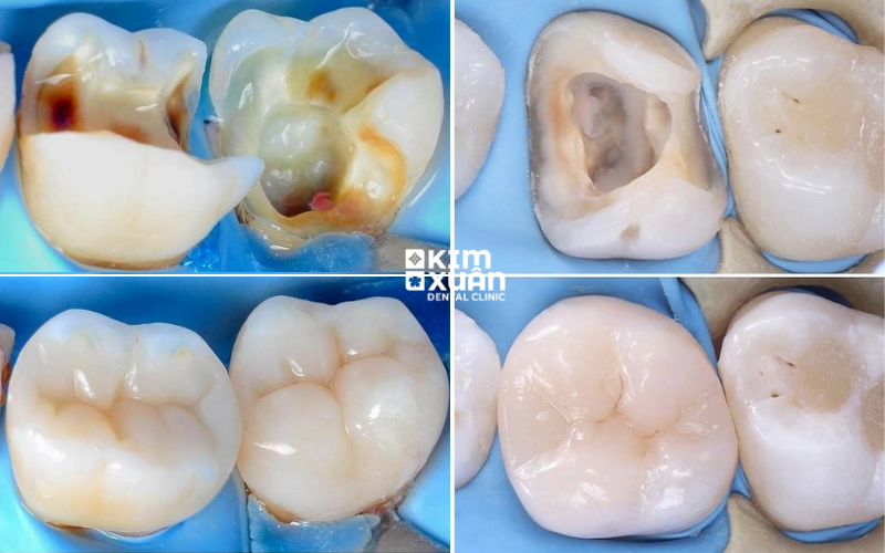 Trám Răng Sâu Tại Nha Khoa Uy Tín