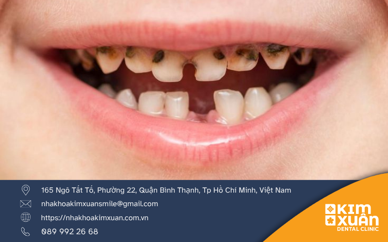 Trám Răng Sữa Có Đau Không
