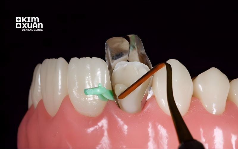 Trám Răng Thẩm Mỹ Có Bền Không