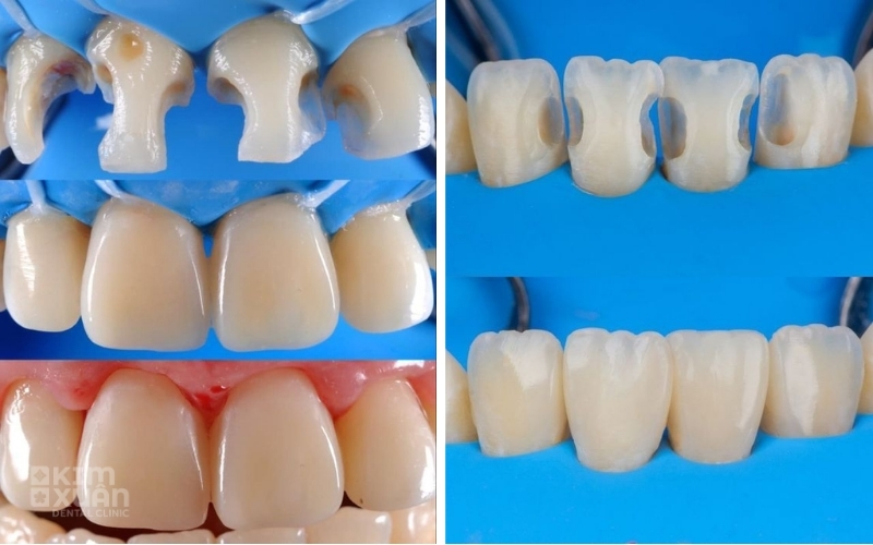 Trám Răng Thẩm Mỹ Giá Bao Nhiêu