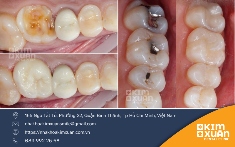 Trám Răng Thẩm Mỹ Giá Bao Nhiêu
