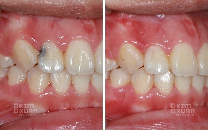 Trám Răng Thẩm Mỹ Giá Bao Nhiêu Tiền