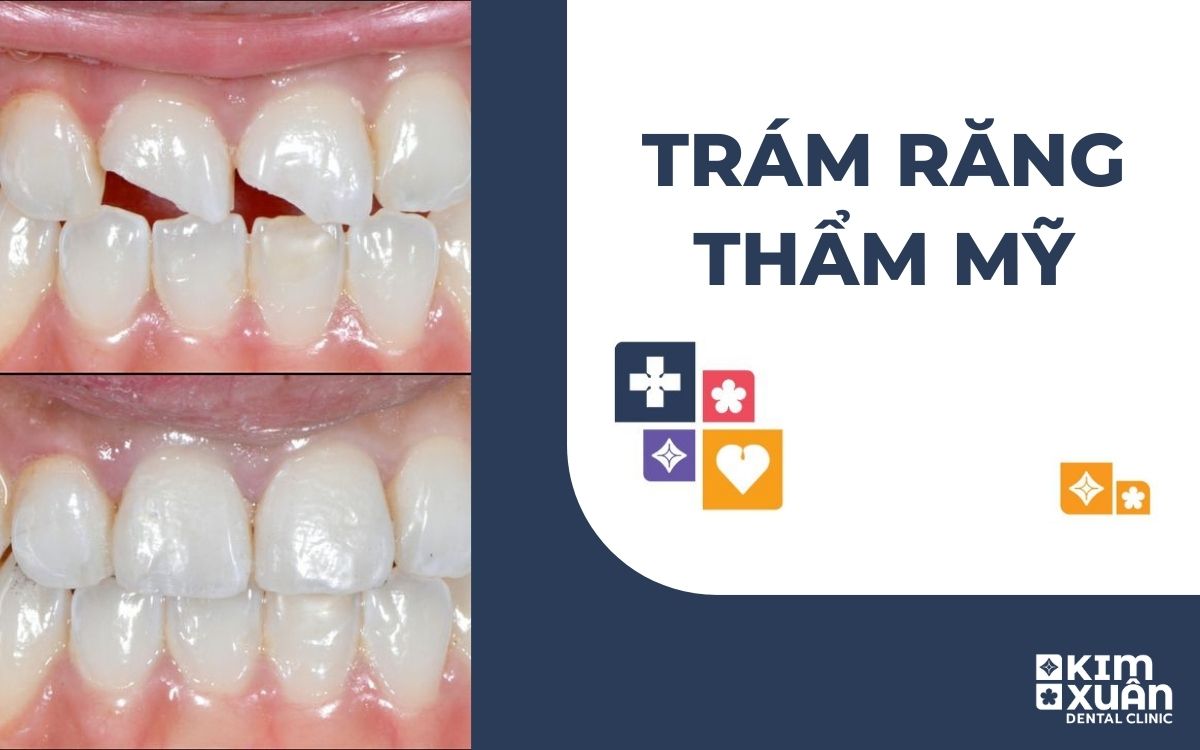 Trám Răng Thẩm Mỹ