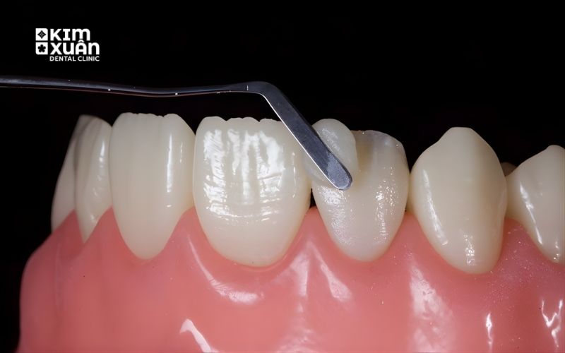 Trám Răng Thẩm Mỹ Là Gì