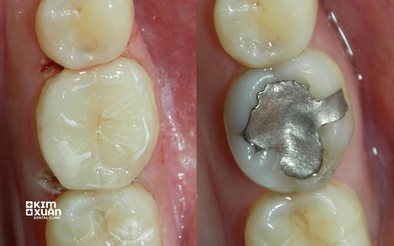 Trám Răng Thẩm Mỹ Tại Nha Khoa Kim Xuân