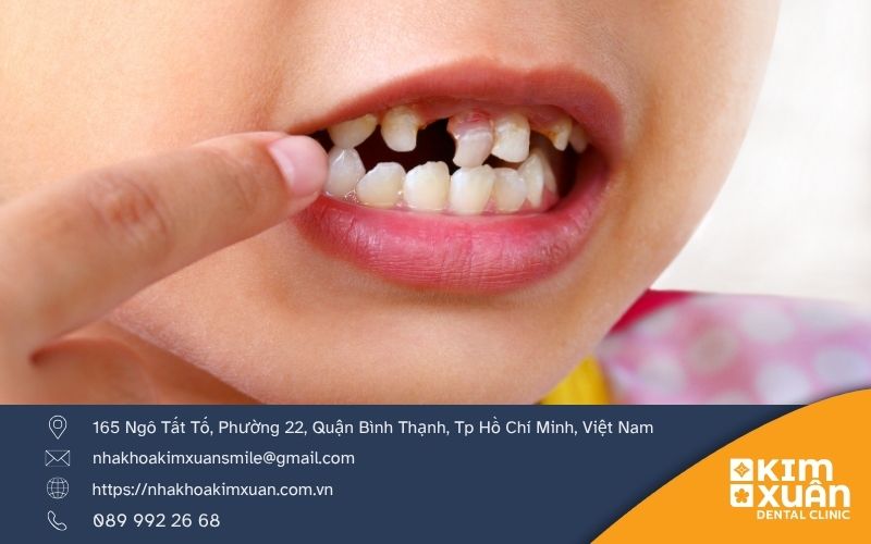 Trẻ Nghiến Răng Có Nguy Hiểm không