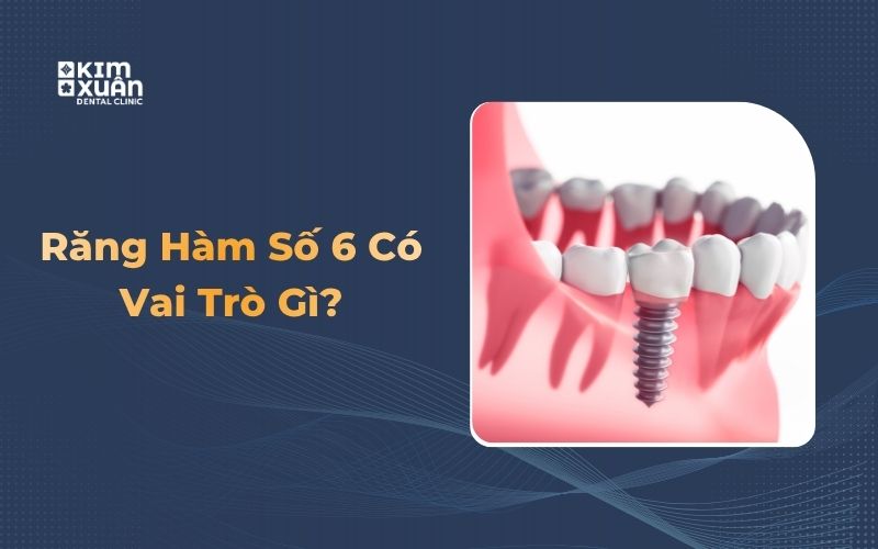 Trồng răng implant răng số 6