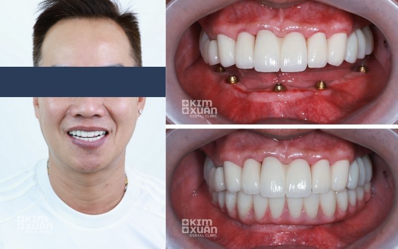 Trồng Răng Implant Tại Nha Khoa Kim Xuân Bình Thạnh TP. HCM