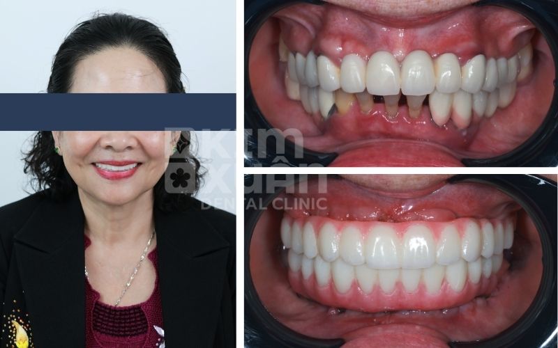 Trồng Răng Giả Cho Người Già Chi Phí Bao Nhiêu