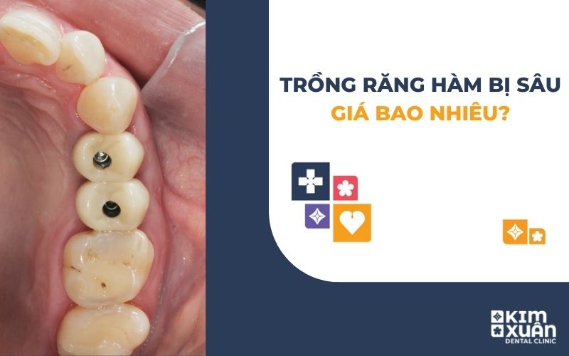 Trồng Răng Hàm Bị Sâu Giá Bao Nhiêu