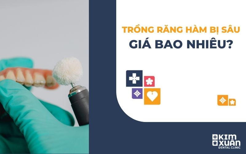 Trồng Răng Hàm Bị Sâu Giá Bao Nhiêu