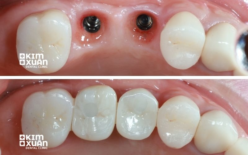 Trồng Răng Hàm Bị Sâu Tại Nha Khoa Kim Xuân
