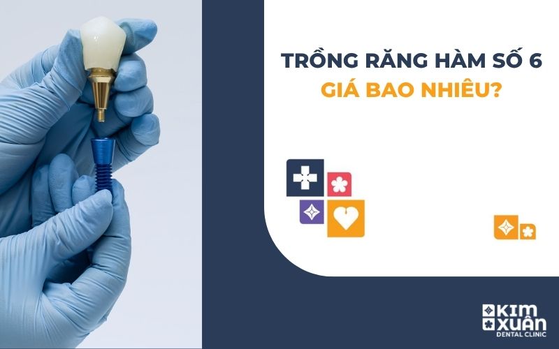 Trồng răng hàm số 6 giá bao nhiêu tiền