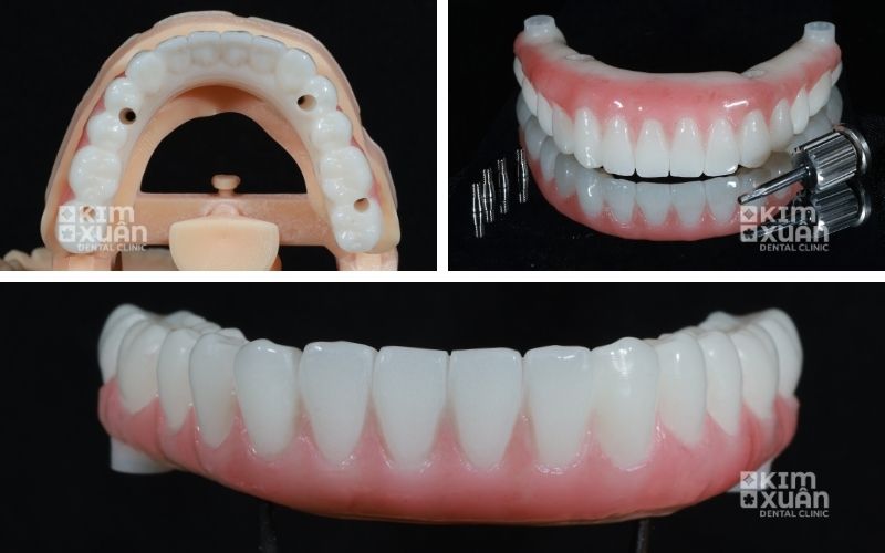 Trồng Răng Implant Toàn Hàm Cho Người Lớn Tuổi Giá Bao Nhiêu 2026