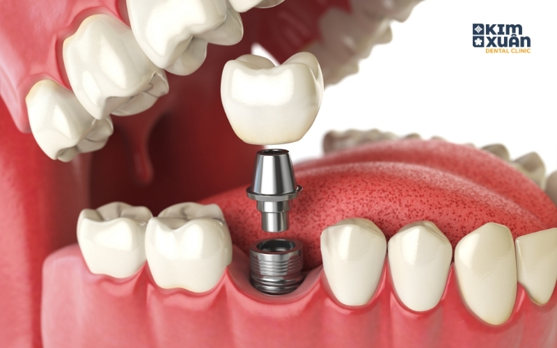 Trồng Răng Implant