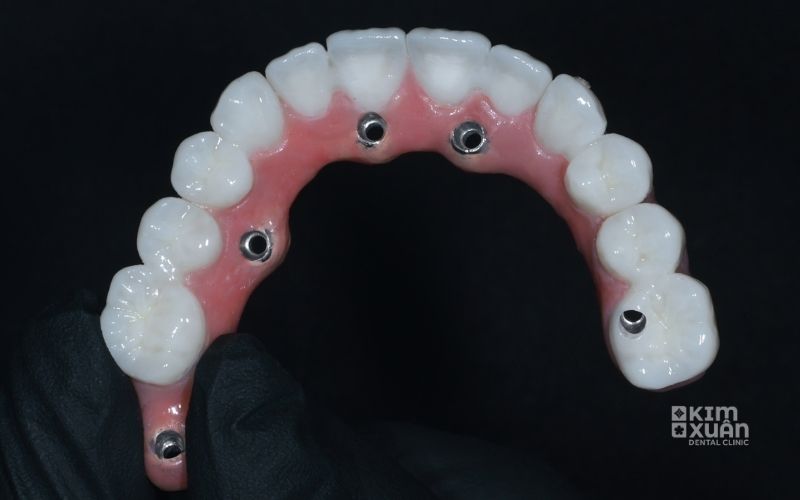 Trồng Răng Implant