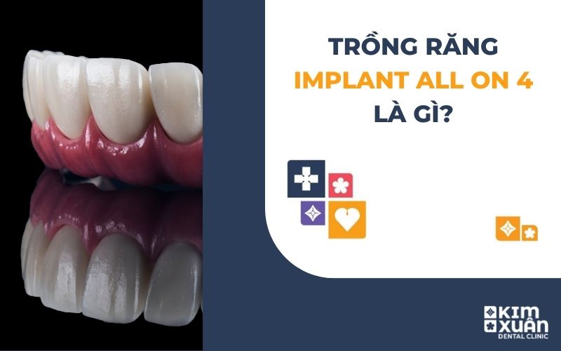 Trồng Răng Implant All On 4
