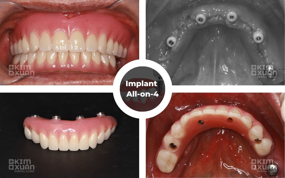 Trồng Răng Implant All -l On - 4