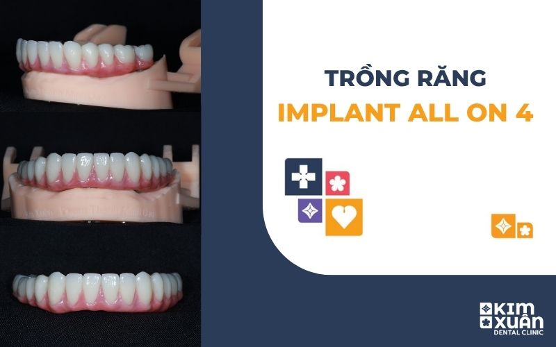 Trồng Răng Implant All On 4