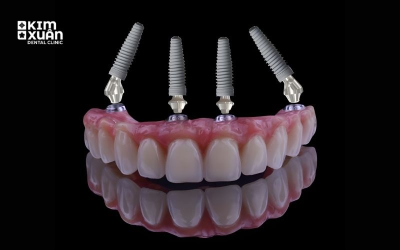 Trồng Răng Implant All On 4 Tại Nha Khoa Kim Xuân