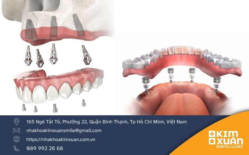 Trồng Răng Implant All On 4 Tại Nha Khoa Kim Xuân