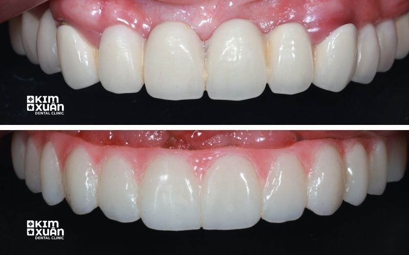 Trồng Răng Implant All On 6 Giá Bao Nhiêu
