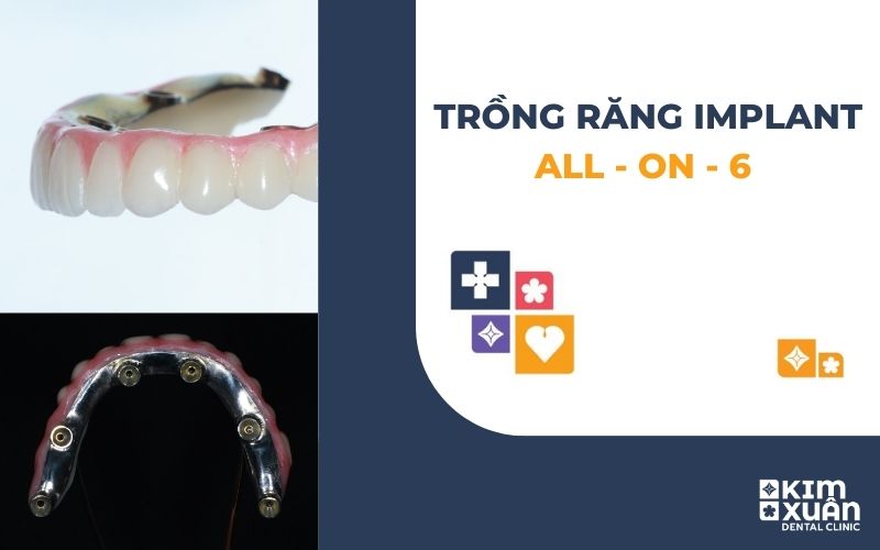 Trồng Răng Implant All On 6 Là Gì?