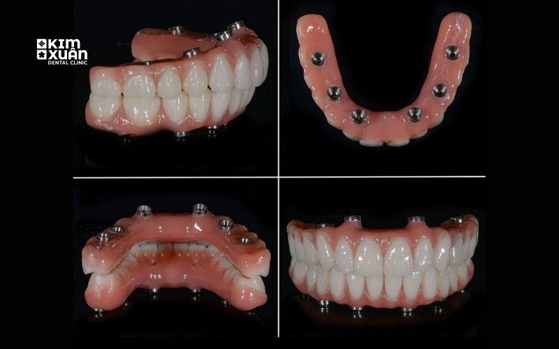 Trồng Răng Implant All On 6 Ở Đâu Uy Tín Tại TP. HCM