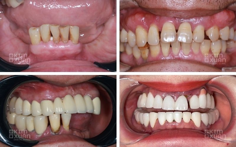 Trồng Răng Implant All On 6 Tại Nha Khoa Kim Xuân