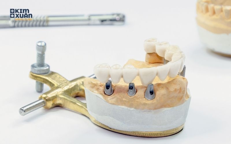 Trồng Răng Implant Bao Lâu thì Hoàn Tất