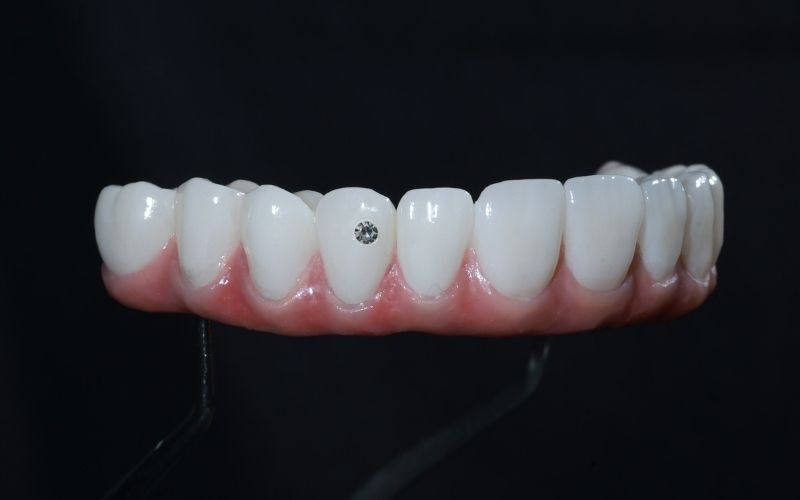 Trồng Răng Implant Có Đau Không