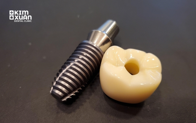 Trồng Răng Implant Có Tốt Không