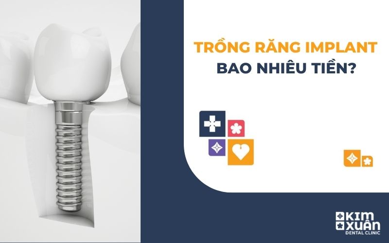 Trồng Răng Implant Giá Bao Nhiêu