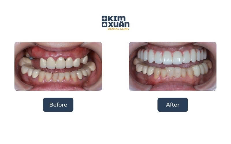 Trồng Răng Implant Giá Bao Nhiêu
