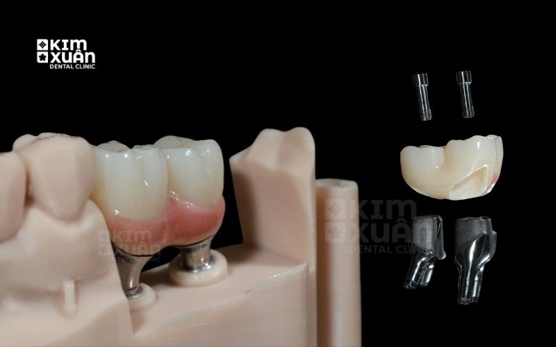 Trồng Răng Implant Giá Rẻ