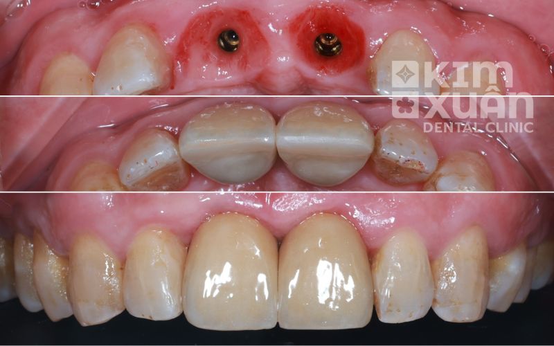 Trồng Răng implant Hiossen Tại Nha Khoa Kim Xuân