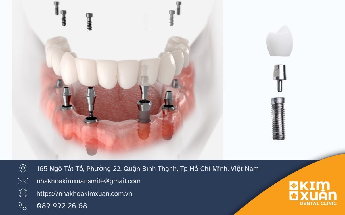 Trồng Răng Implant.