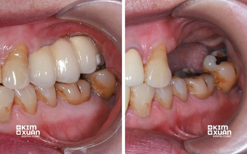 Trồng Răng Implant Khi Bị Tiêu Xương Hàm