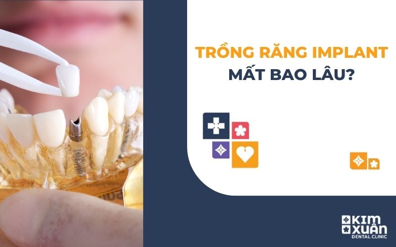 Trồng Răng Implant Mất Bao Lâu