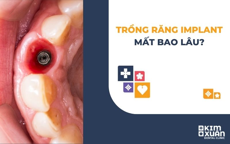 Trồng Răng Implant Mất Bao Lâu