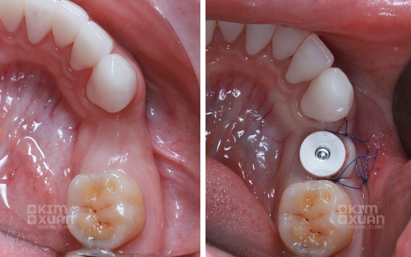Trồng Răng Implant Mis C1 tại Nha Khoa Kim Xuân